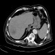 Abscess in liver, cholangoitis, maturation, first CT: CT - Computed tomography