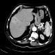 Abscess in liver, cholangoitis, maturation, second CT: CT - Computed tomography