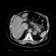 Adrenal myelolipoma: CT - Computed tomography