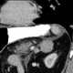 Adrenal myelolipoma: CT - Computed tomography