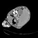 Carcinoma of adrenal gland, adrenal carcinoma: CT - Computed tomography