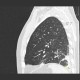 Accessory interlobium: CT - Computed tomography