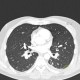 Accessory interlobium: CT - Computed tomography
