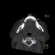 Accessory salivary gland, Stafne's defect: CT - Computed tomography