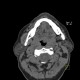 Accessory salivary gland, Stafne's defect: CT - Computed tomography