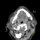 Accessory salivary gland, Stafne's defect: CT - Computed tomography