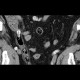 Acute appendicitis: CT - Computed tomography