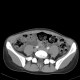 Colitis, acute colitis of the right colon, cecum and ascendens: CT - Computed tomography