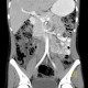 Colitis, acute colitis of the right colon, cecum and ascendens: CT - Computed tomography