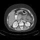 Acute pancreatitis: CT - Computed tomography