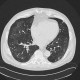 Hypersensitivity angiitis, intraalveolar hemorrhage, HRCT: CT - Computed tomography