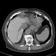 Amiodarone liver: CT - Computed tomography