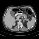 Mesenteric abscess, gastroenteroanastomosis, end-to-side, small-bowel stenosis: CT - Computed tomography