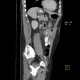 Mesenteric abscess, gastroenteroanastomosis, end-to-side, small-bowel stenosis: CT - Computed tomography