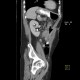 Mesenteric abscess, gastroenteroanastomosis, end-to-side, small-bowel stenosis: CT - Computed tomography