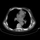 Carcinosis of pericard and pleura, empyema, nephrectomy: CT - Computed tomography