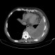 Carcinosis of pericard and pleura, empyema, nephrectomy: CT - Computed tomography