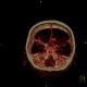 Aneurysm of internal carotid artery, left: CT - Computed tomography