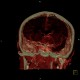 Aneurysm of internal carotid artery, left: CT - Computed tomography