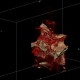 Aneurysm of internal carotid artery, left: CT - Computed tomography