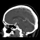 Aneurysm of internal carotid artery, left: CT - Computed tomography