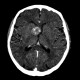 Aneurysm of internal carotid artery, left: CT - Computed tomography