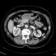 Gastritis, acute, antral: CT - Computed tomography