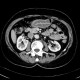 Gastritis, acute, antral: CT - Computed tomography