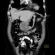 Gastritis, acute, antral: CT - Computed tomography