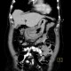 Gastritis, acute, antral: CT - Computed tomography