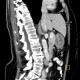 Gastritis, acute, antral: CT - Computed tomography