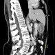 Gastritis, acute, antral: CT - Computed tomography