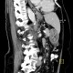 Gastritis, acute, antral: CT - Computed tomography