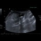 Acute appendicitis, appendicolith: US - Ultrasound