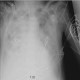 ARDS: X-ray - Plain radiograph