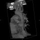 Arteria lusoria, anomally of the subclavian artery, right: CT - Computed tomography