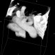 Arteria lusoria, anomally of the subclavian artery, right: CT - Computed tomography