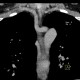 Arteria lusoria, anomally of the subclavian artery, right: CT - Computed tomography