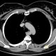 Arteria lusoria, anomally of the subclavian artery, right: CT - Computed tomography