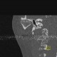 Arthrosis of temporomandibular joint, osteoarthritis: CT - Computed tomography