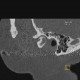 Arthrosis of temporomandibular joint, osteoarthritis: CT - Computed tomography