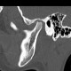 Arthrosis of temporomandibular joint, TMJ: CT - Computed tomography