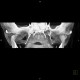 Arthrosis of temporomandibular joint, TMJ: CT - Computed tomography