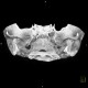 Arthrosis of temporomandibular joint, TMJ: CT - Computed tomography