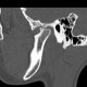 Arthrosis of temporomandibular joint, TMJ: CT - Computed tomography