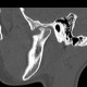 Arthrosis of temporomandibular joint, TMJ: CT - Computed tomography