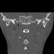 Arthrosis of temporomandibular joint, TMJ: CT - Computed tomography