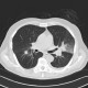 Angioinvasive aspergilosis: CT - Computed tomography