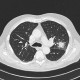 Aspergilloma, aspergillosis, angio-invasive aspergillosis, doubling time, initial scan: CT - Computed tomography