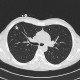 Aspergiloma, invasive aspergilosis: CT - Computed tomography